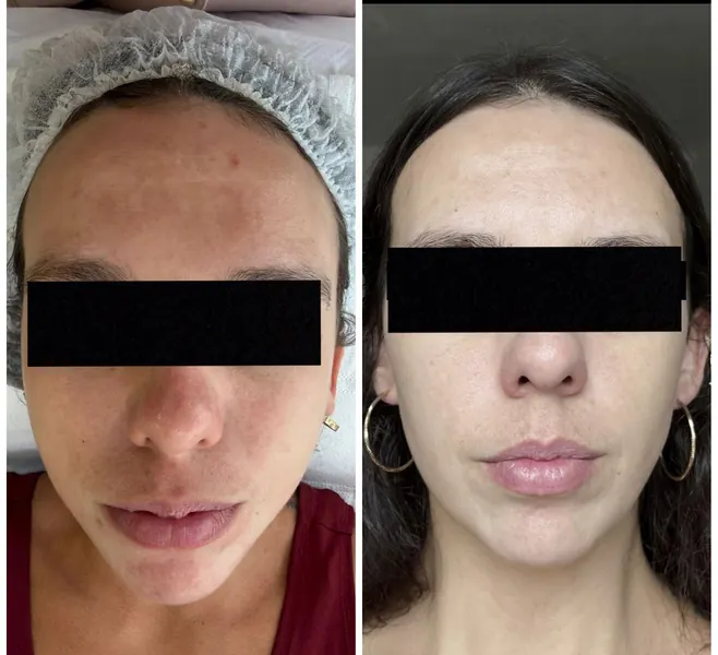 Antes e depois de melasma — resultado 1