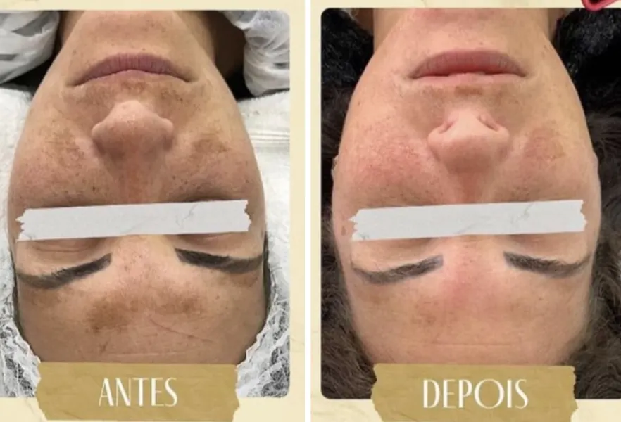 Antes e depois de melasma — resultado 2