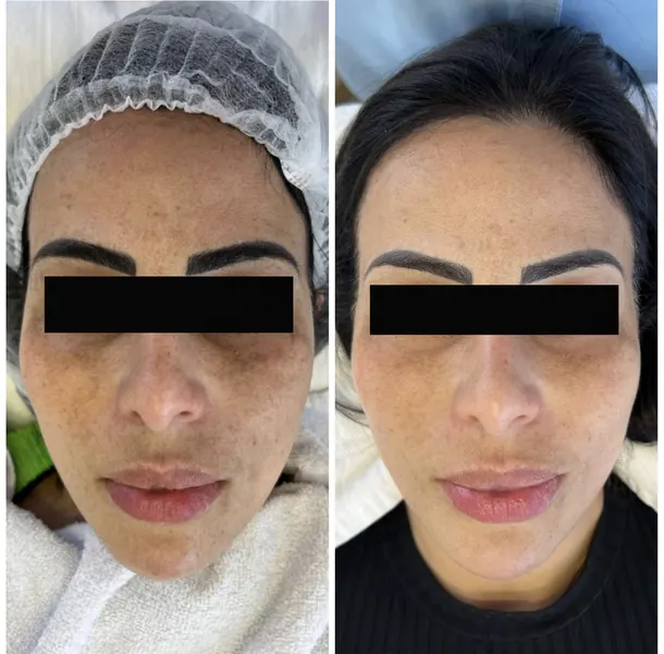 Antes e depois de melasma — resultado 3