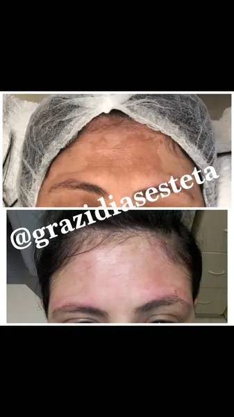 Antes e depois de melasma — resultado 4