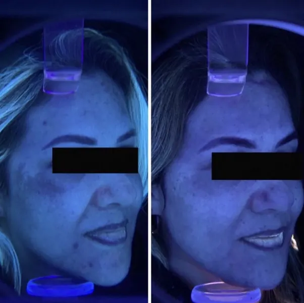 Antes e depois de melasma — resultado 5