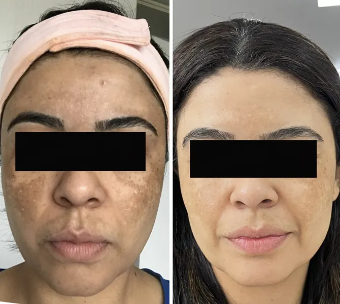 Antes e depois de melasma — resultado 6