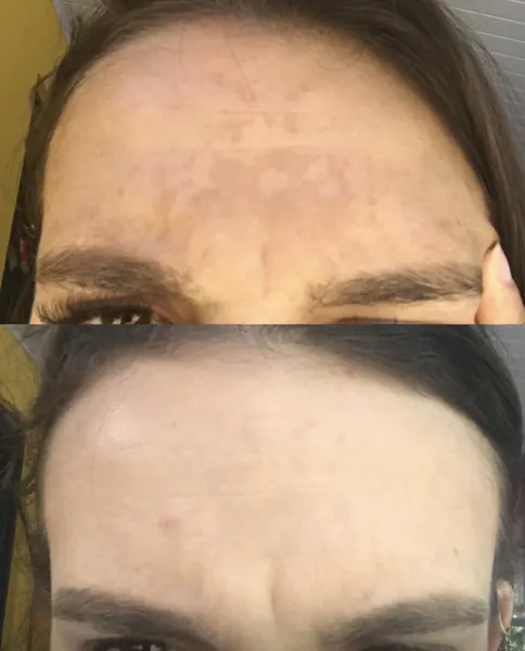 Antes e depois de melasma — resultado 7